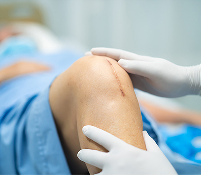 Arthroscopic Knee Surgery: A Minimally Invasive Solution for Knee Problems