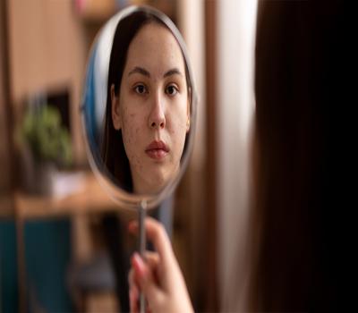 Acne Treatment Options: What Really Works?