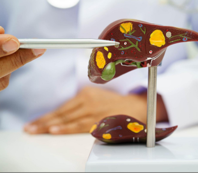 Gallstones: Symptoms, Diagnosis, and Surgical Treatment Options 