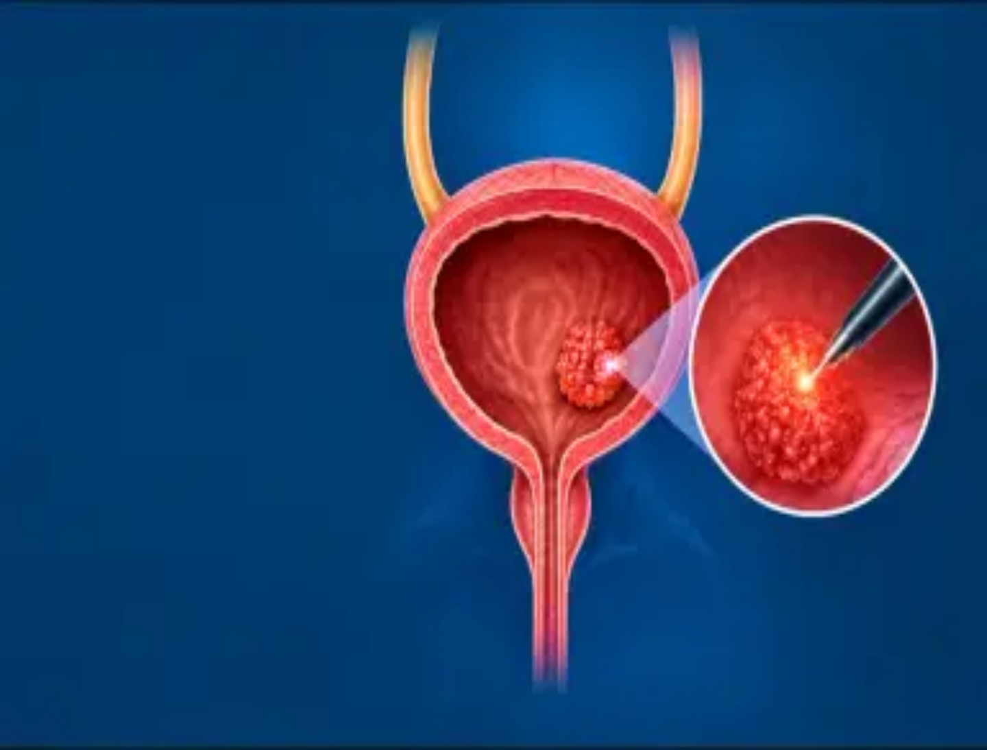 Can Bladder Cancer be Treated Without Removing the Bladder?