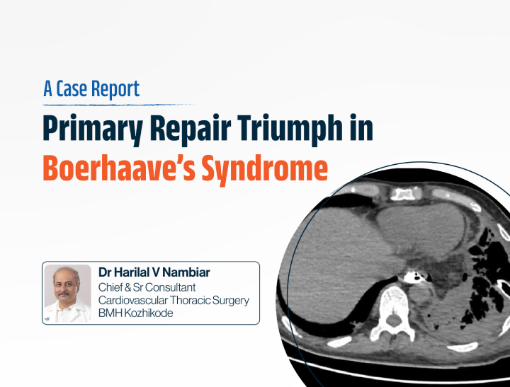 Delayed Presentation of Boerhaave’s Syndrome Successfully Managed with Primary Esophageal Repair and Omental Patch Reinforcement