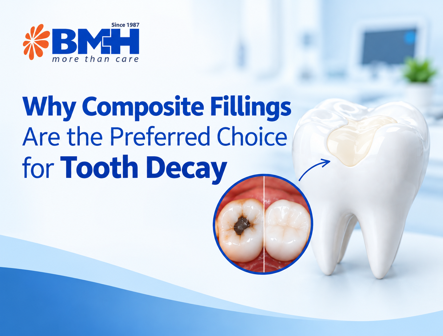 Why Composite Fillings Are the Preferred Choice for Tooth Decay