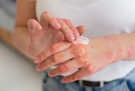   Common Skin Disorders: Psoriasis, Eczema and How to Treat Them 